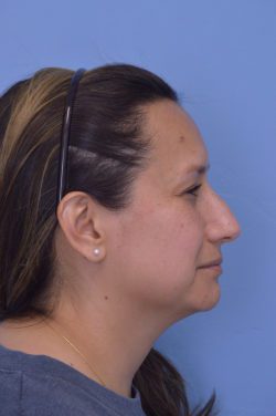 Rhinoplasty