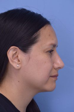 Rhinoplasty