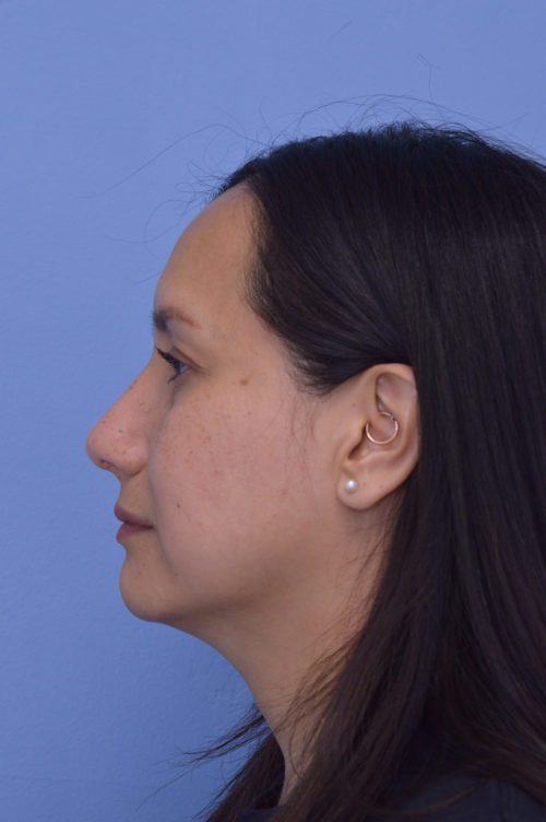 Rhinoplasty