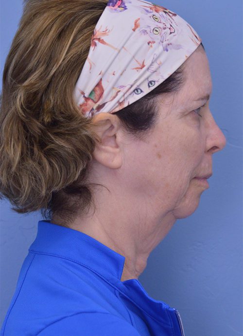 Face and Neck Lift