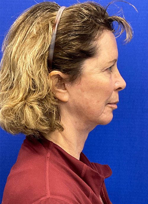 Face and Neck Lift