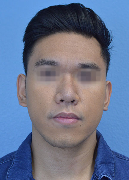 Chin Augmentation Case 7945 Before Photo Chin Augmentation