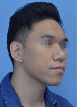 Chin Augmentation