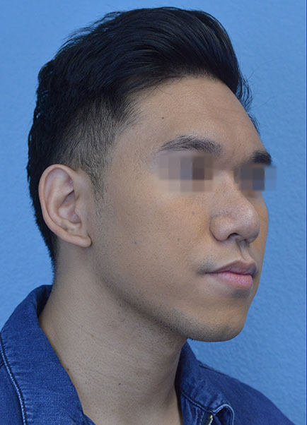 Chin Augmentation Case 7945 Before Photo Chin Augmentation