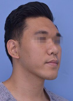 Chin Augmentation