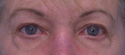 Blepharoplasty