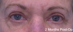 Blepharoplasty