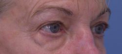 Blepharoplasty