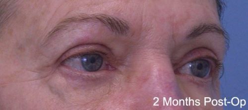 Blepharoplasty