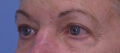 Blepharoplasty