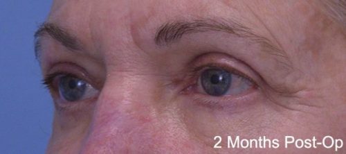 Blepharoplasty