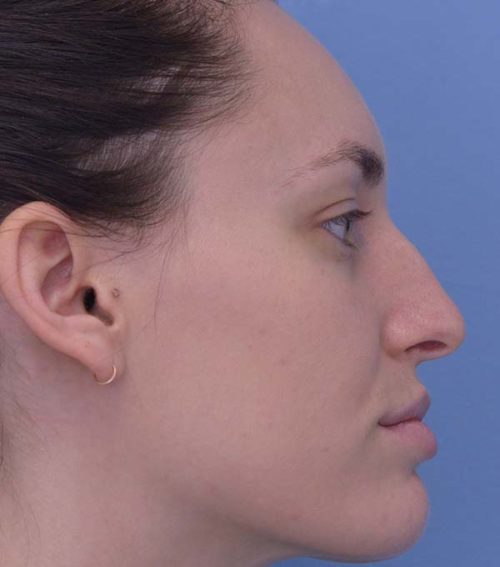 Rhinoplasty