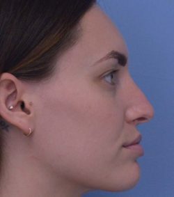 Rhinoplasty