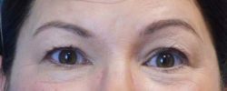 Blepharoplasty