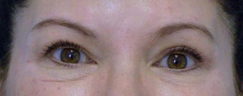 Blepharoplasty