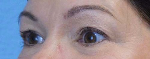 Blepharoplasty