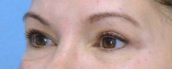 Blepharoplasty