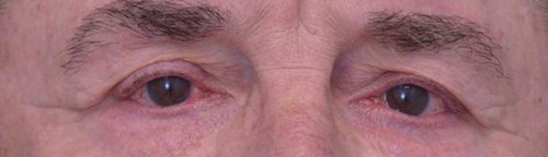 Blepharoplasty