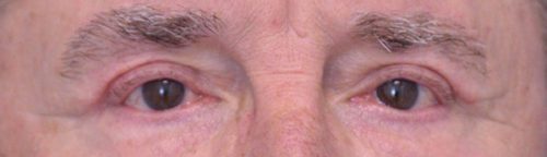 Blepharoplasty