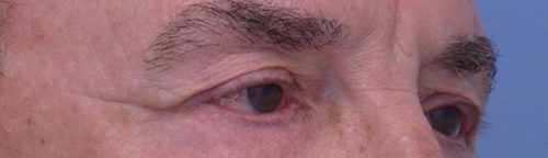 Blepharoplasty