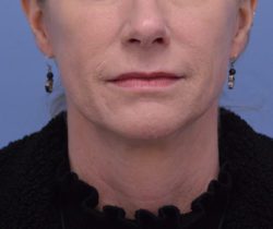 Face and Neck Lift