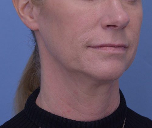 Face and Neck Lift