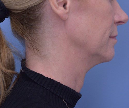 Face and Neck Lift