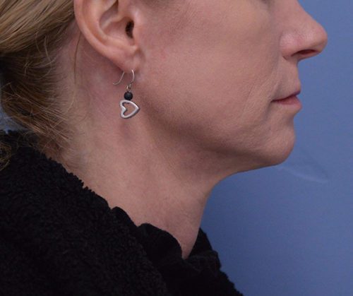 Face and Neck Lift