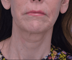 Face and Neck Lift