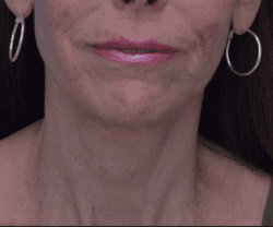 Face and Neck Lift