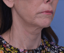 Face and Neck Lift