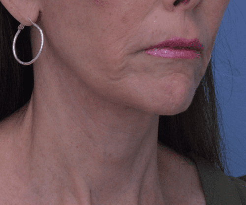 Face and Neck Lift