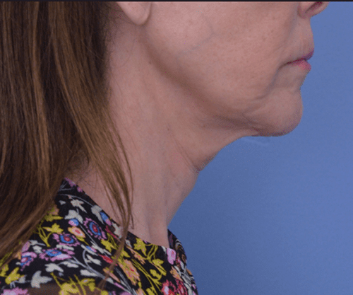 Face and Neck Lift