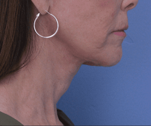 Face and Neck Lift