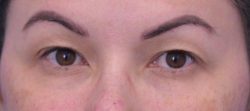 Blepharoplasty