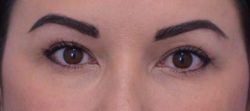 Blepharoplasty