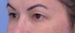 Blepharoplasty