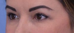 Blepharoplasty