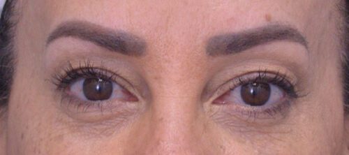 Blepharoplasty