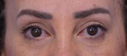 Blepharoplasty