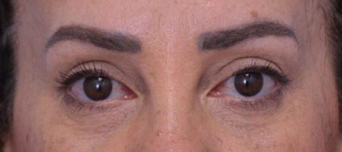 Blepharoplasty