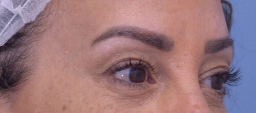 Blepharoplasty