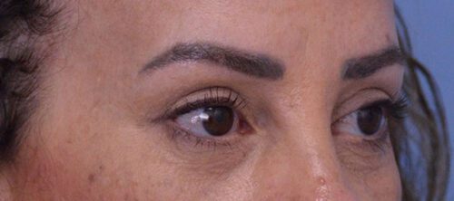 Blepharoplasty