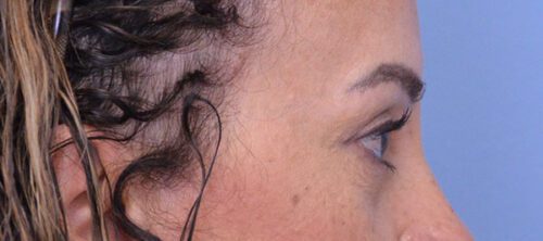 Blepharoplasty