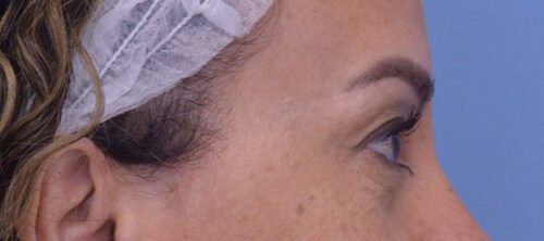 Blepharoplasty