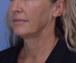 Face and Neck Lift