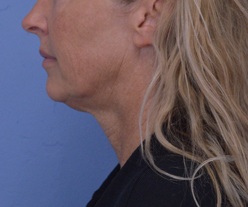 Face and Neck Lift