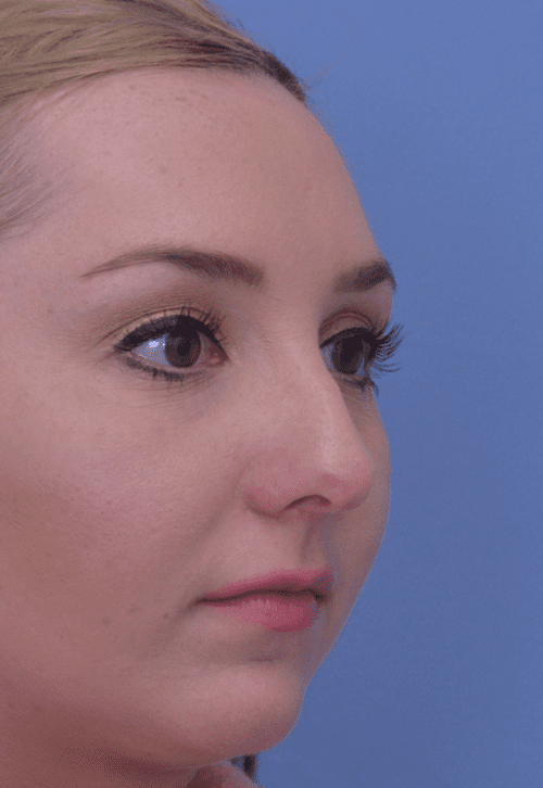 Rhinoplasty