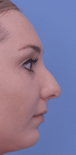 Rhinoplasty