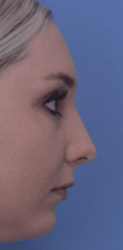 Rhinoplasty